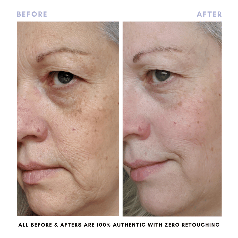 Sarah's Triple Threat | For Acne-Prone Maturing Skin