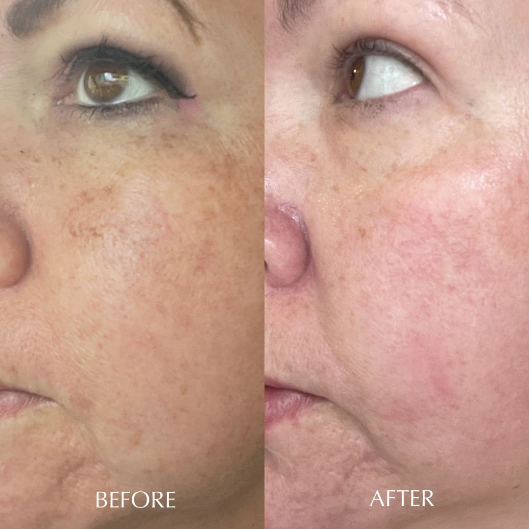 EPIDERMAL GROWTH FACTOR CREAM