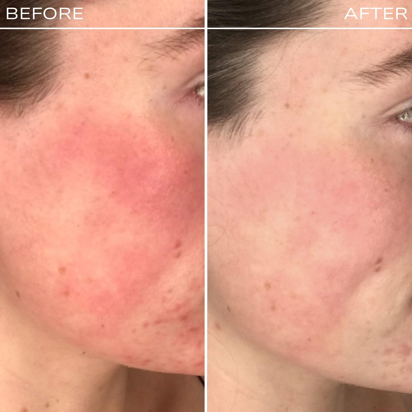 Redness Rescue Cream (RRC)